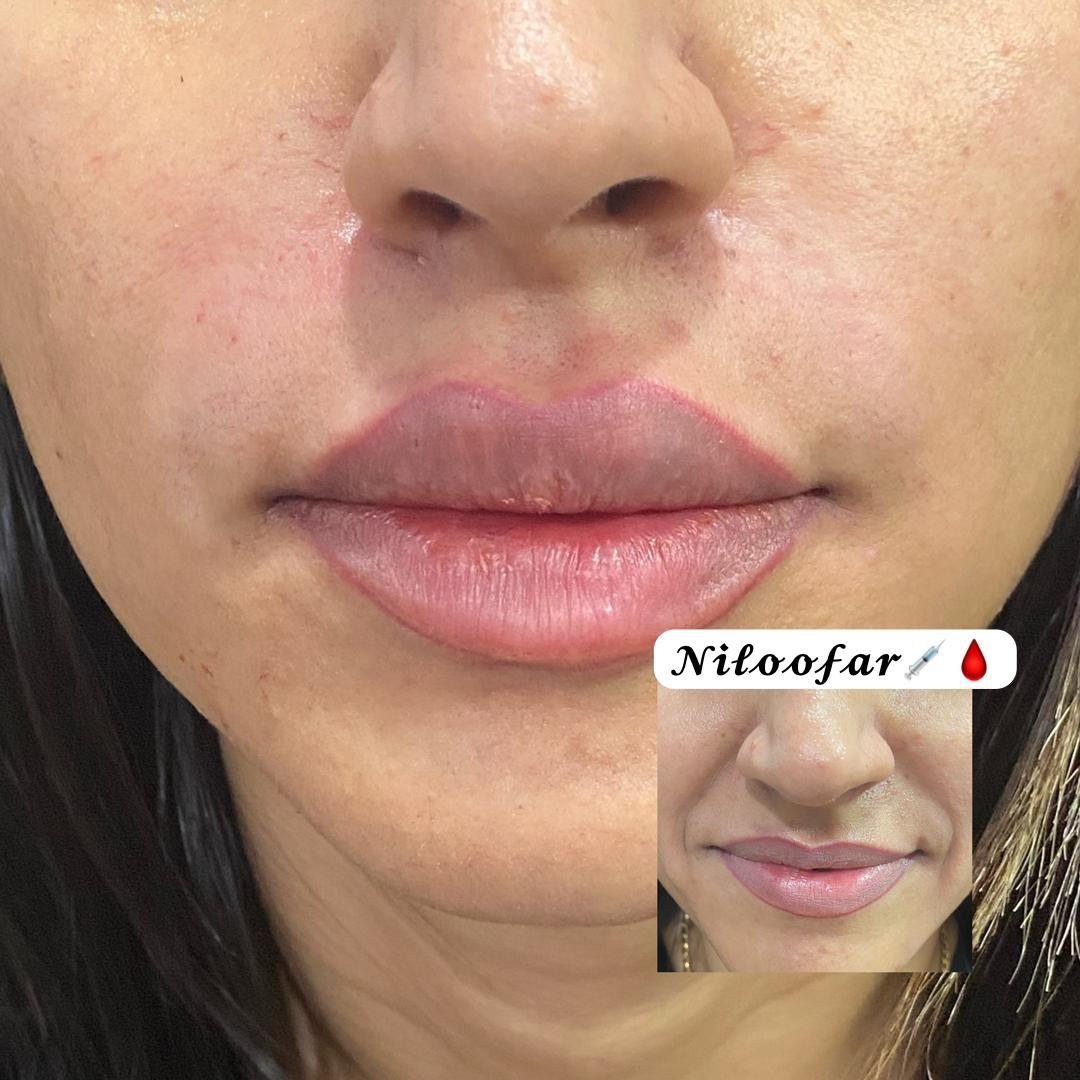 خدمات ژل و بوتاکس نیلوفر زرگر