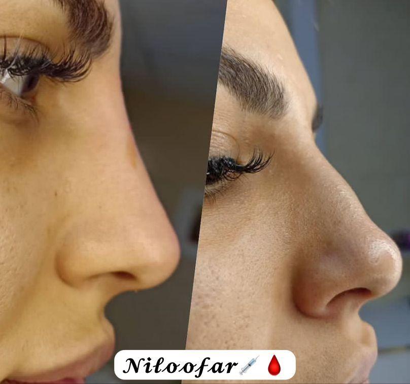 خدمات ژل و بوتاکس نیلوفر زرگر