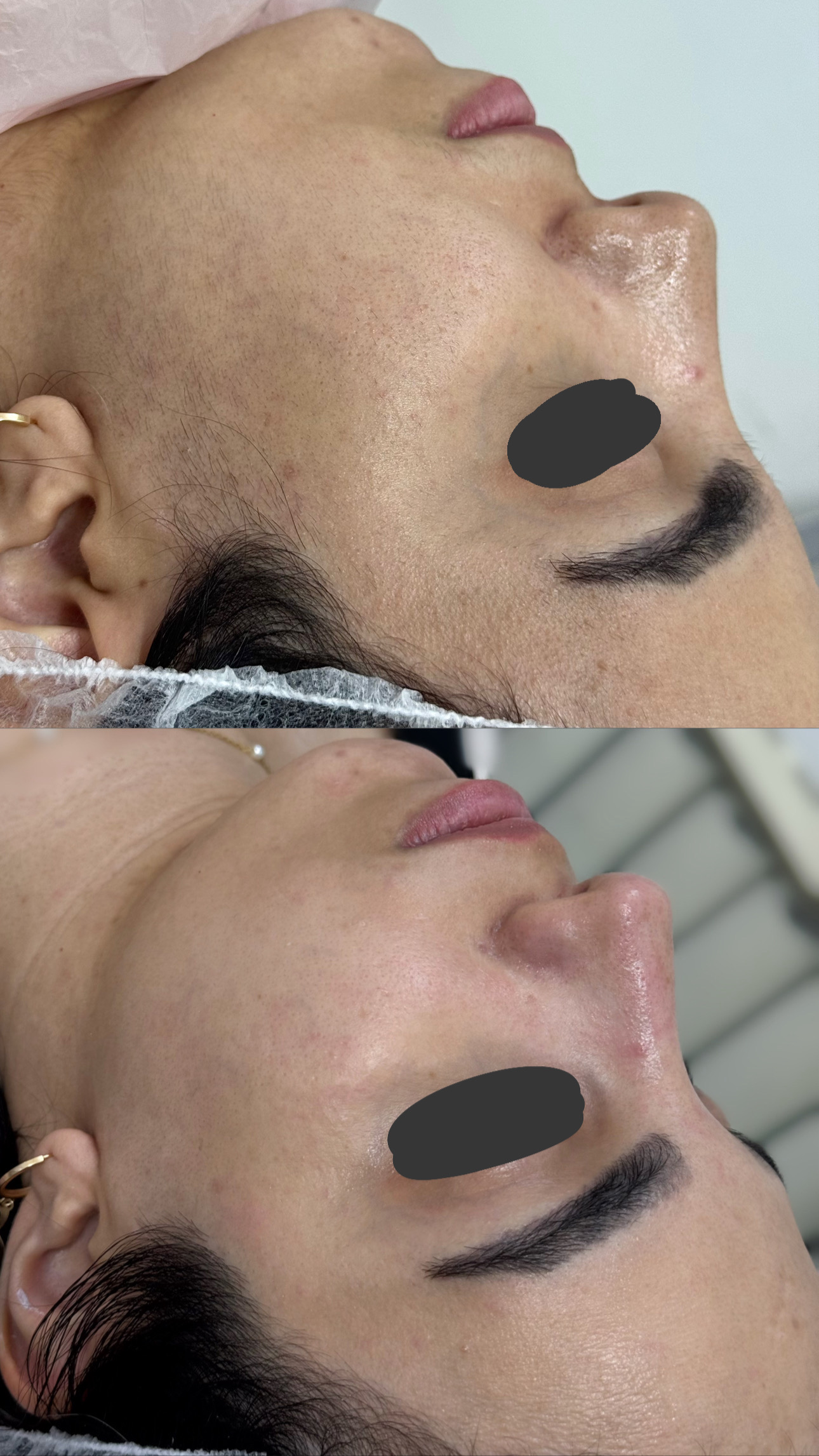 خدمات درماپلنینگ vip با اصلاح ابروی رایگان