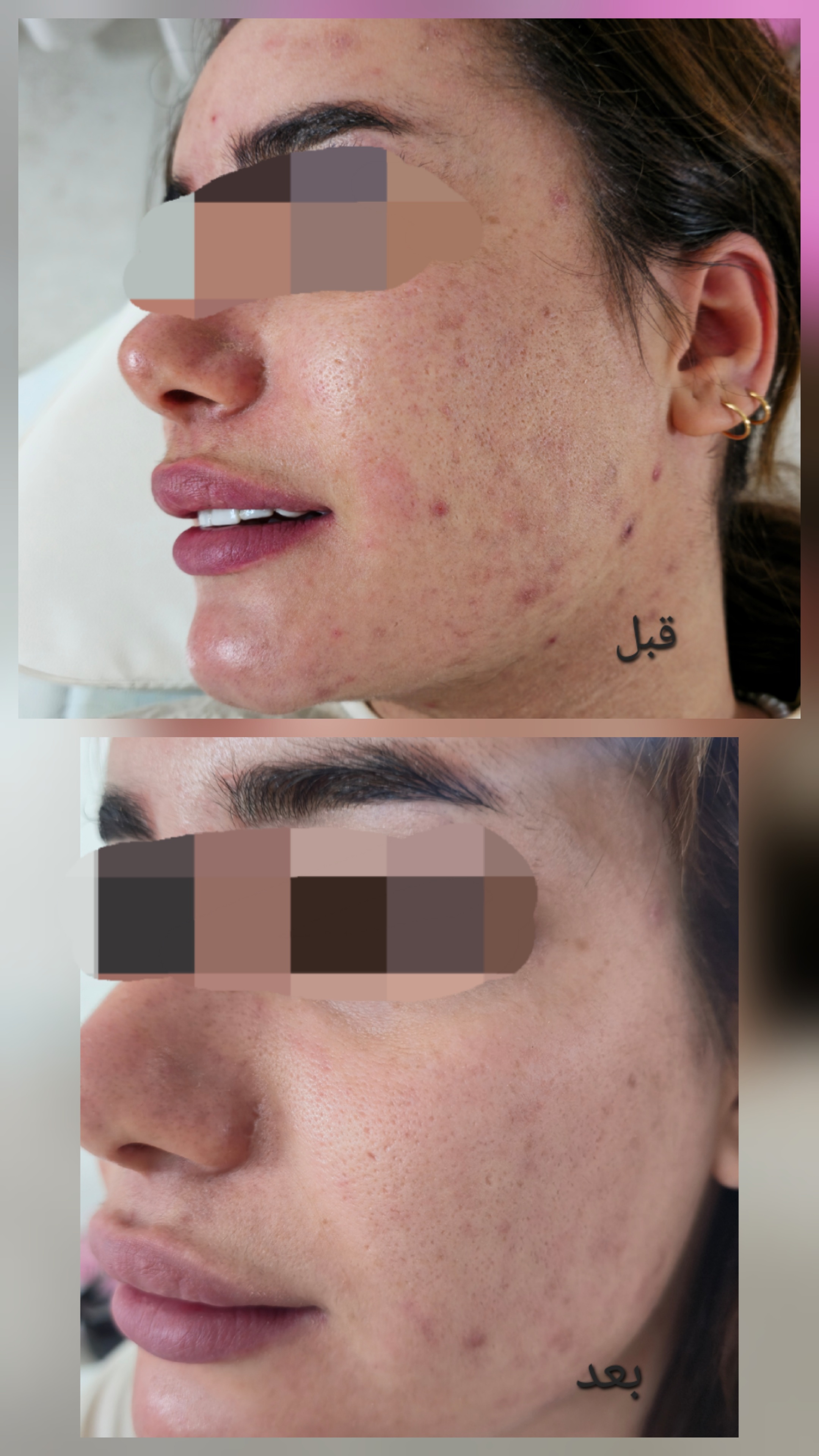فیشیال و خدمات پاکسازی پوست الهام اورا